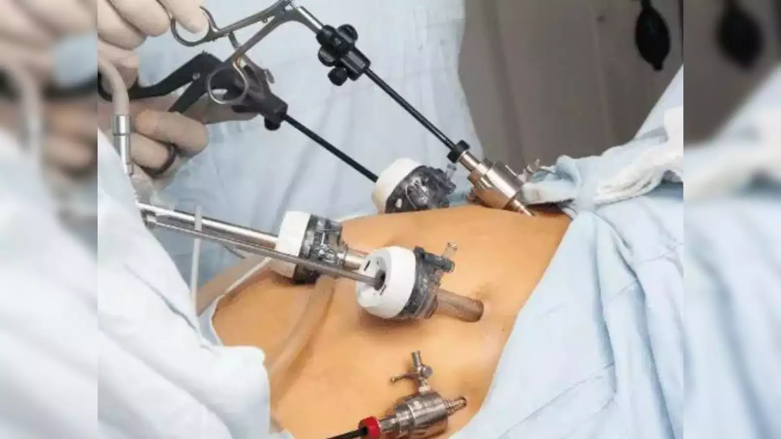 hernia-surgery-success-report
